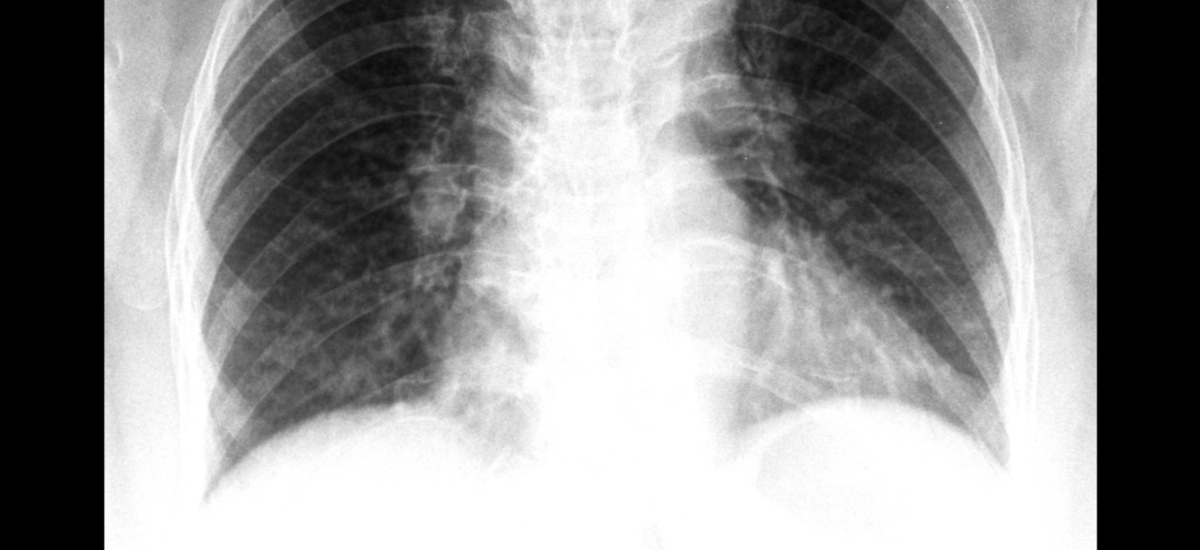 Lung Cancer ICD-10 Code