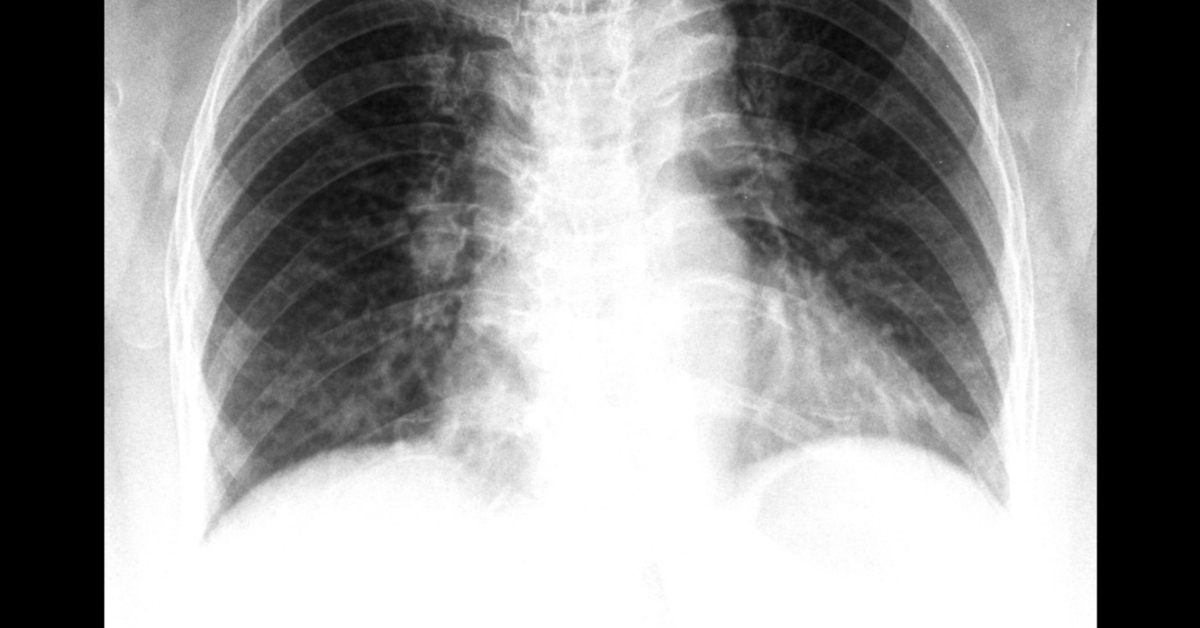Understanding Your Lung Cancer ICD-10 Code: A Complete Patient Guide